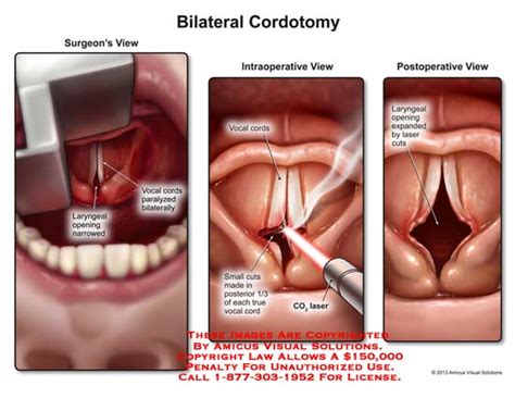 AMICUS Illustration of amicus,surgery,bilateral,cordotomy,laryngeal ...