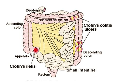 Terminal Ileitis - Treatment, Symptoms, Causes, Pictures | HubPages