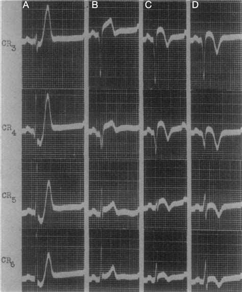 De Winter T Wave • LITFL • ECG Library Diagnosis