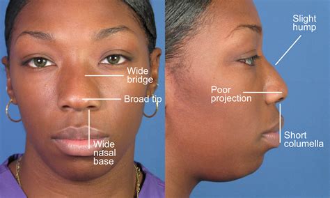 African American Rhinoplasty