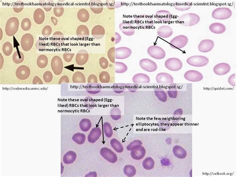 Haematology in a NutShell: Pernicious Anemia (Vit B12 Deficiency Anemia)