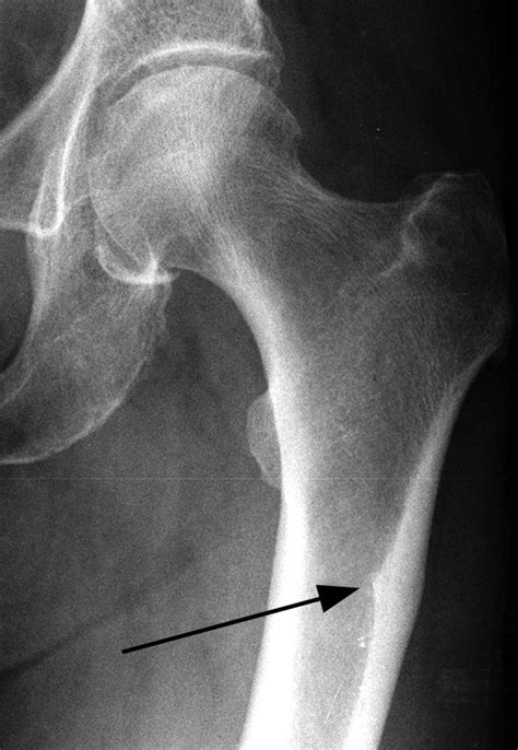 Atypical femoral fractures and bisphosphonate treatment | Bone & Joint