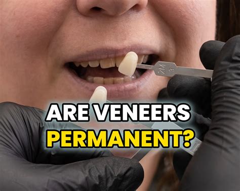 Permanent Dental Veneers: The 8 Most Important Points to Know