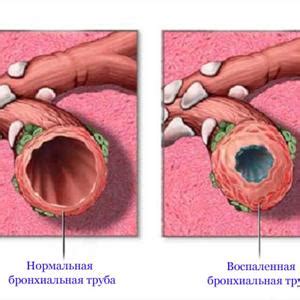 Allergic Bronchitis Cough Treatment - Natural Bronchitis Treatments 6 ...