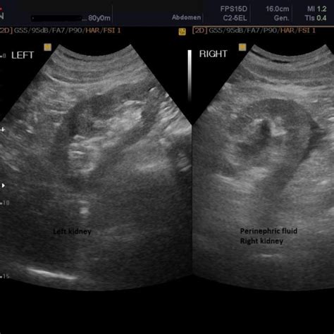 Perinephric Fat Stranding Ultrasound