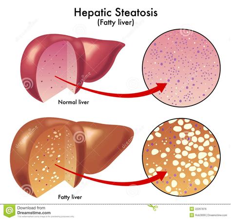 Simple hints plus diet guidance on how to avoid kidney stones. The foods you eat and drink have ...