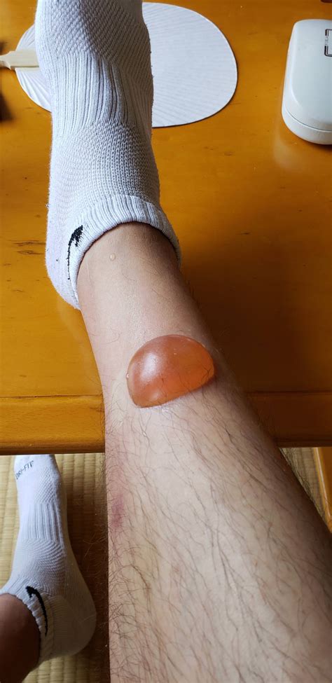 HUGE blister from mosquito(?) bite : AskDocs