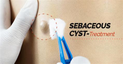 Sebaceous Cyst Treatments