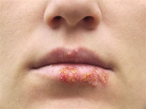 Herpes - Types, Symptoms, Causes & Treatments | Organic Facts