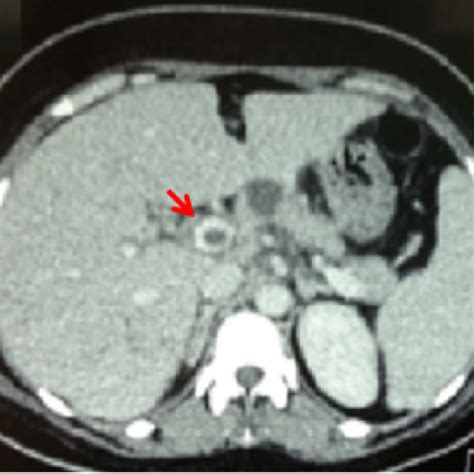 Septic pylephlebitis: A rare complication of acute appendicitis | Eurorad