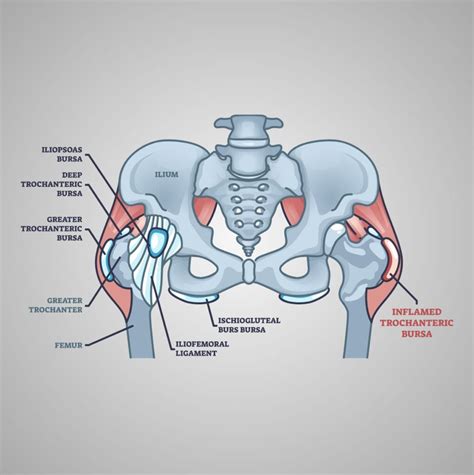 Trochanteric Bursitis - Los Angeles, CA - Dr. Jason Snibbe