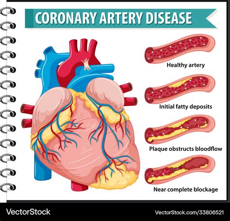 Coronary Artery Disease Nursing Diagnosis And Nursing Care Plan - PELAJARAN