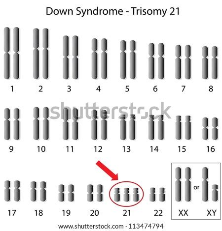 Down Syndrome Karyotype Stock Photo 113474794 : Shutterstock