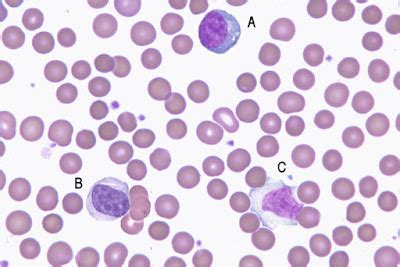 Medical Laboratory and Biomedical Science: Sunday Blood Cell Challenge