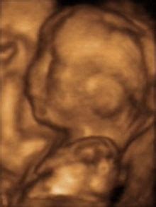 3D ultrasound - Wikipedia