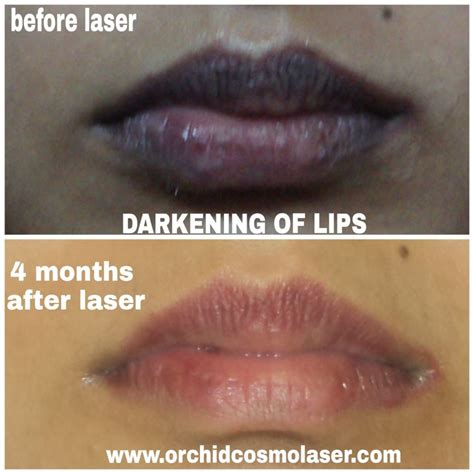 Before / After Images of pigmentation treatment | Orchid Cosmo laser