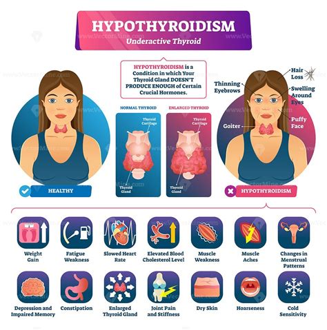 Hypothyroidism vector illustration - VectorMine