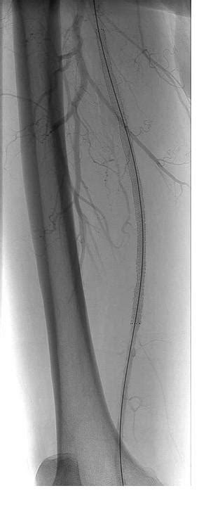 Endovascular Approaches to Chronic Total Occlusion of the Superficial Femoral Artery - Angiologist