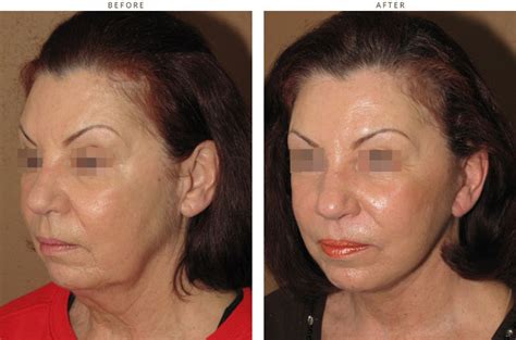 Mini Face Lift – Before and After Pictures * – Dr Turowski – Plastic Surgery Chicago