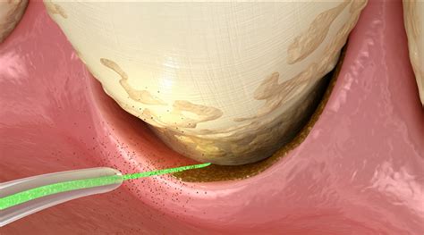 Pros and Cons of laser gum surgery vs traditional gum disease treatmnent