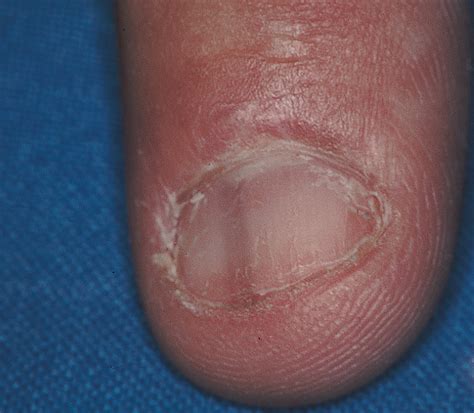 Nail Changes in Patients Infected With Human Immunodeficiency Virus | Dermatology | JAMA ...