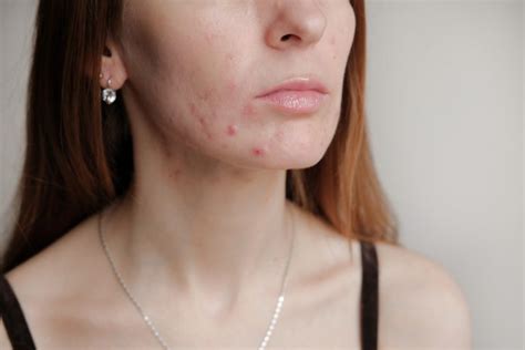 Post-Inflammatory Erythema: How to Treat Acne Red Spots | The Healthy