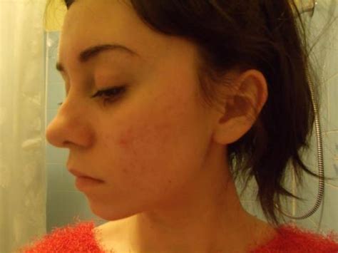 Spironolactone: Need Advice Regarding Dosage! (Picture Included) – Hormonal acne – Acne.org Forum