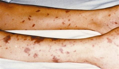 Meningitis: Symptoms, Treatment, Causes, Rash Pictures - YouMeMindBody