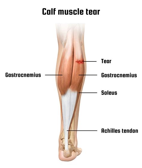 Gastrocnemius Tear: Calf Strain - Dr. Justin Dean