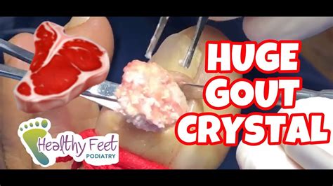 Removing Gout Crystals How To Prevent Gout, 53% OFF