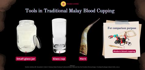 Traditional Malay Blood Cupping - GlobinMed