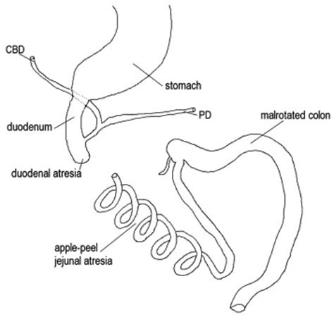 Different types of intestinal atresia in identical twins - Journal of Pediatric Surgery