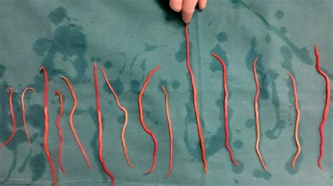 Roundworm In Stool