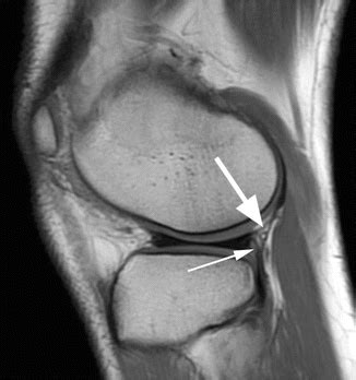 Fibular Collateral Ligament Mri