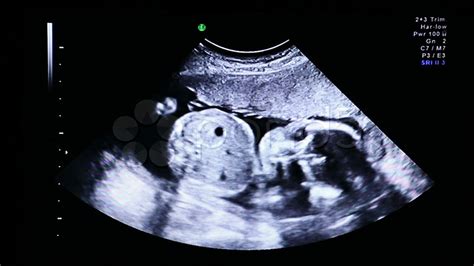 In The Womb Ultrasound. Stock Footage - YouTube