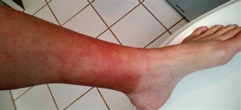 How To Get Rid Of Rash On Legs - Playerhurt30