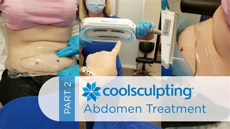 CoolSculpting Treatment: Lower Abdomen (Part 2) - YouTube