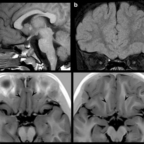 Brain MRI in a 12-year-old TSC subject with bilateral olfactory bulb... | Download Scientific ...