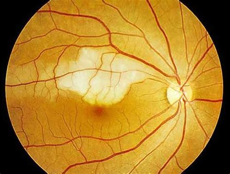 Retinal artery occlusion causes, symptoms, diagnosis, treatment & prognosis