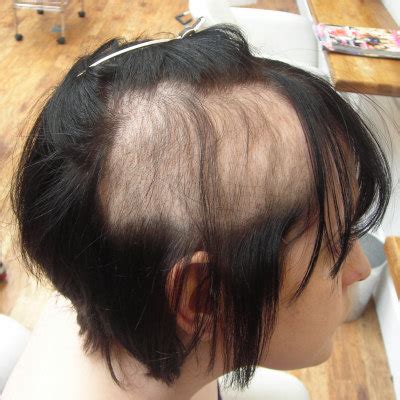 Regrow hair after trichotillomania | Specialist clinic Lahore | call us now