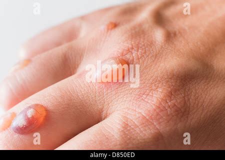 Man's hand covered with blisters caused by cryosurgery - wart removal procedure using liquid ...