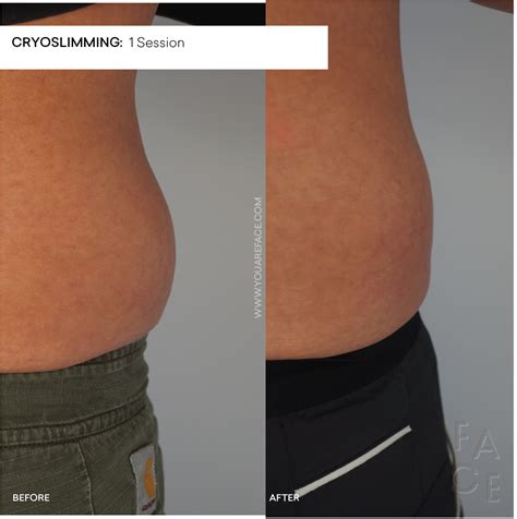 Cryoskin Before and After Stomach Slimming — FACE