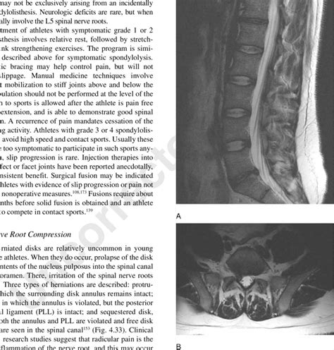 33. Acute right paracentral disk extrusion, seen at the L5-S1 level on ...