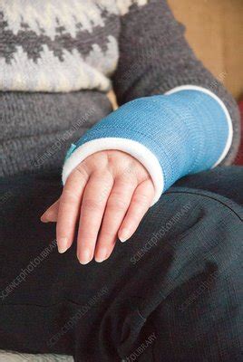 Cast on wrist with Colles' fracture - Stock Image - C036/0112 - Science Photo Library