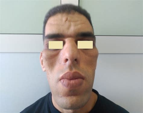 Acromegaly: Acral and Facial changes