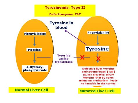 Tyrosinemia, Type II | Hereditary Ocular Diseases