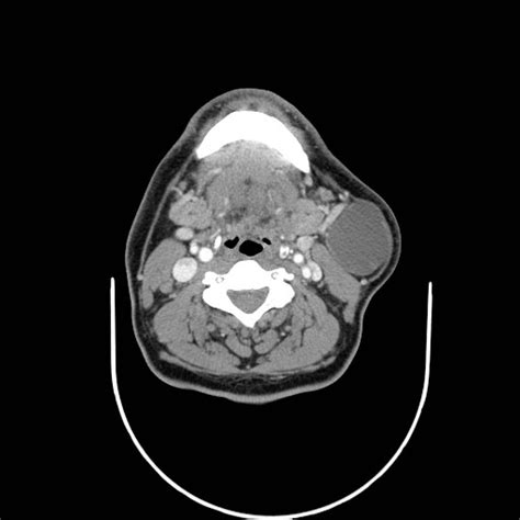 Second branchial cleft cyst | Image | Radiopaedia.org