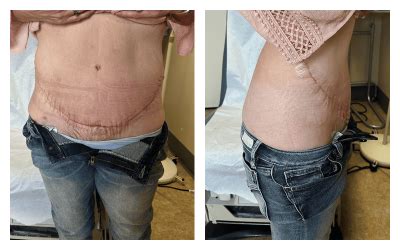 Before & After Tummy Tuck/Panniculectomy Photos - Nevada Surgical