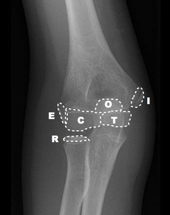 Pediatric elbow radiograph (an approach) | Radiology Reference Article | Radiopaedia.org