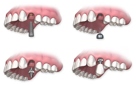 Single Tooth Dental Implants